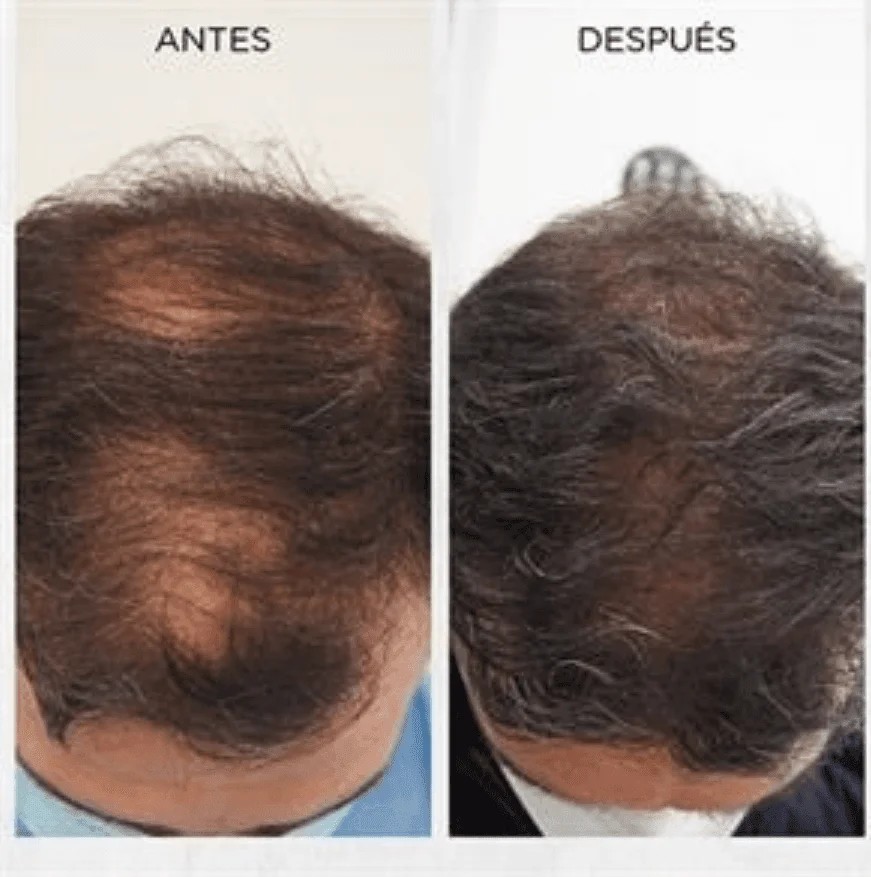 Revitalización Capilar (PRP)