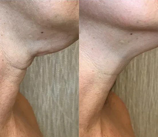 Lifting Cuello, Escote o Manos (Fibroblast)